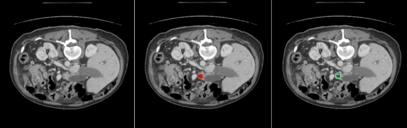 Pancreatic CT anomaly detection figure showing original scan, ground truth, and anomaly map